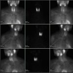 Nukleárna medicína: Dodávky izotopov sú stabilné, ale ich zraniteľnosť pretrváva
